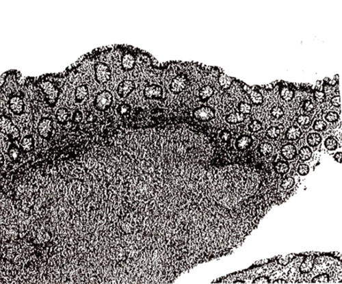 Histologic sections of colonic mucosa and submucosa demonstrating extensive infiltration by confluent non-necrotizing granulomas. The extensive granulomatous inflammation is characteristic of sarcoidosis (AmeriPath GI Institute)