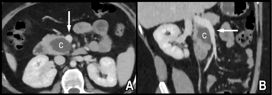 Water attenuation cystic lesion (c) in pancreas broadly contacts SMV (arrow).