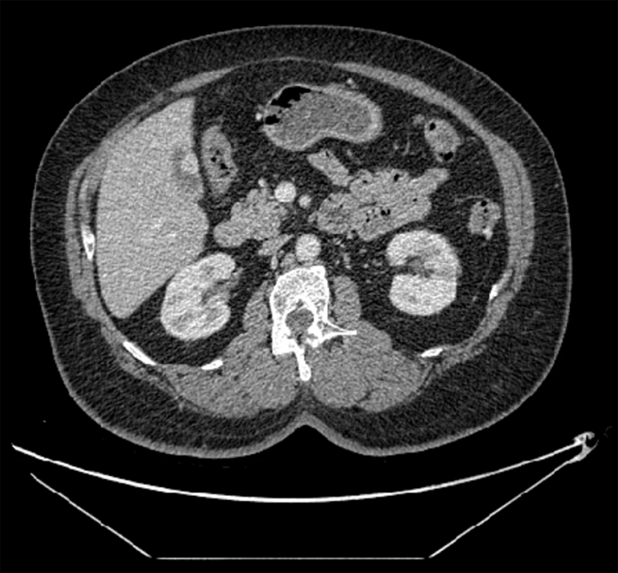 Presentation, Imaging, and Management of a Rare Case of Paraganglioma ...