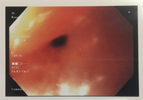 Image reveals smooth extrinsic compression with severe narrowing of duodenal lumen at junction of bulb and second portion
