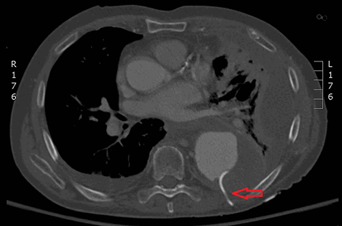 Figure 2. Axial CT angiogram chest demonstrating pigtail catheter visible in TAA sac with no active extravasation of contrast. Arrow indicates catheter.