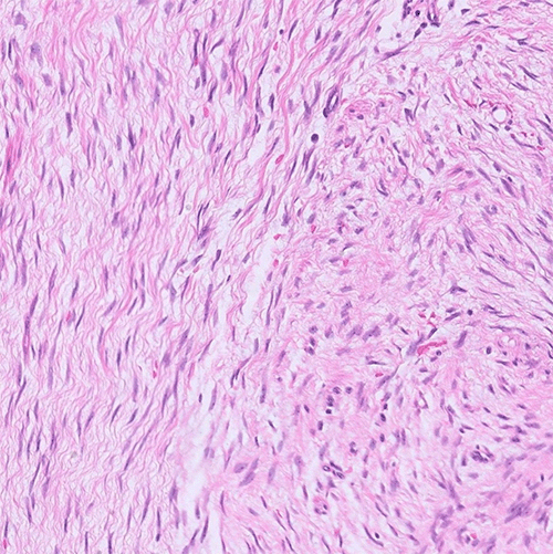 B Proliferation of spindle-shaped cells featuring elongated, slender, and uniformly shaped nuclei with pale cytoplasm set within a collagenous stroma