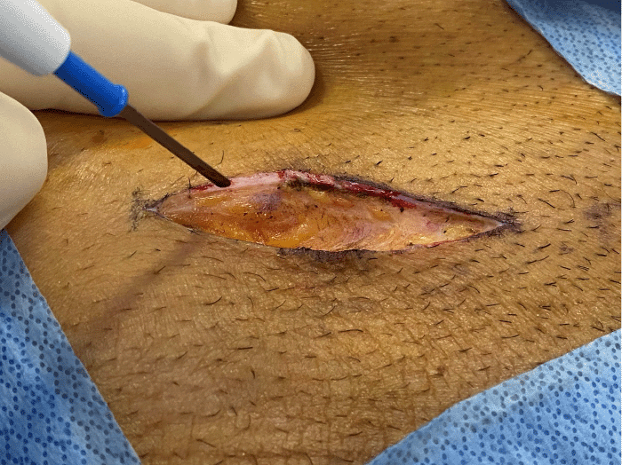 B) Standard result of electrocautery control of dermal bleeding with thermal injury