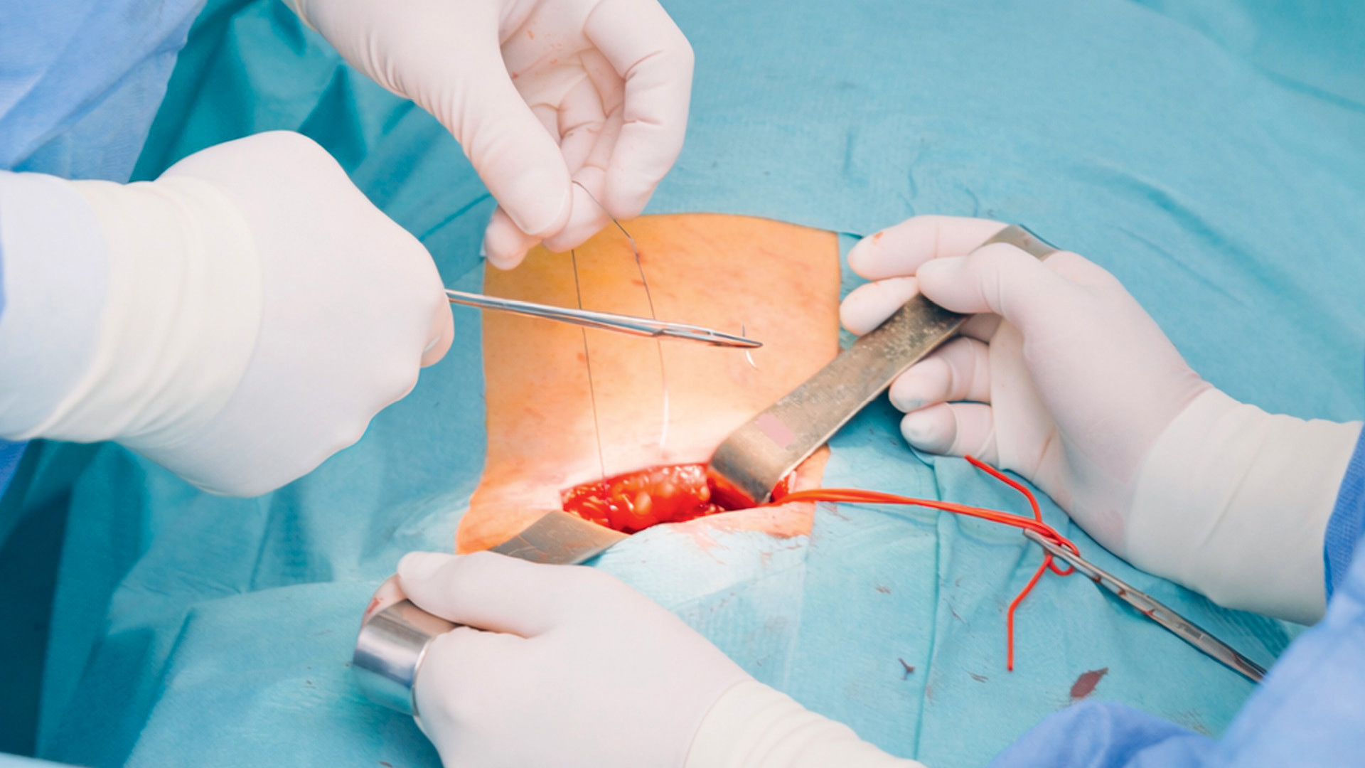 Hernia Surgery