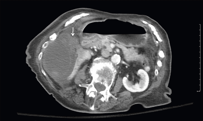 Image demonstrates a significantly distended gallbladder with a contained pericholecystic fluid collection secondary to perforation. Thickened soft tissue density at the pedicle suggested gallbladder volvulus (arrow). Note significant mass effect on the inferior right hepatic lobe.