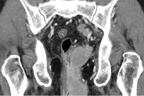 Hyperdense mass in left ischiorectal fossa, extending into left supralevator space