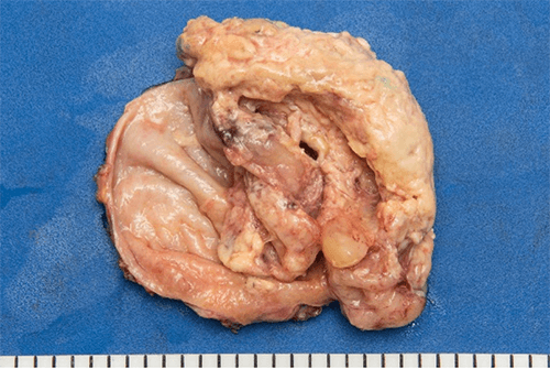 Figure 4: Patient’s gallbladder opened to reveal 10 x 5.5 x 4 cm mass