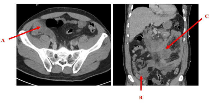 (A) Axial view showing the appendix with surrounding inflammatory infiltration (stranding) and a suspected TB abscess). (B) Coronal view of the appendix with findings similar to panel A, including stranding and a suspected TB abscess. (C) Coronal view demonstrating a mass lesion within the duodenum concerning for a TB abscess. Additionally, enlarged lymph nodes are present in the vicinity, suggestive of inflammation.