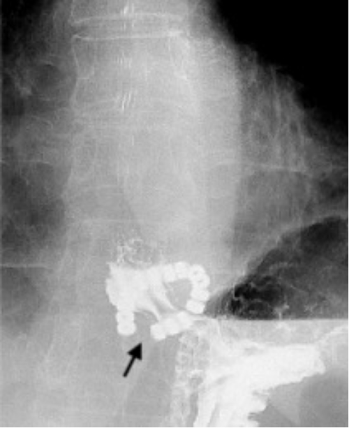 Illustrating discontinuity in the posterior section of the LINX device during contrast passage.  B) Following contrast passage through the device, separation is evident between the posterior beads (indicated by arrow).