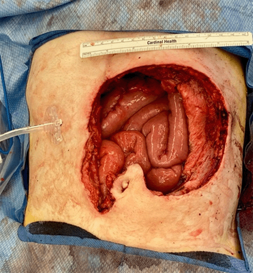 C) resultant abdominal wall defect with newly-sited gastrostomy tube