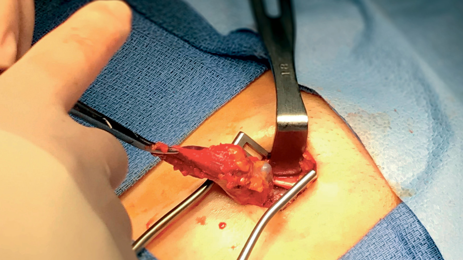 Hernia Repair Isn’t a One-Size-Fits-All Procedure