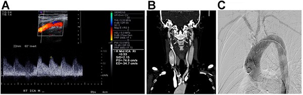 Figure 1. This patient’s carotid artery duplex ultrasound (A) showing normal carotid artery waveforms and velocities, (B) computed tomography angiogram showing supra-aortic trunk vessel lesions, and (C) aortic arch angiography with heavy atherosclerotic burden in the supra-aortic trunk vessels.