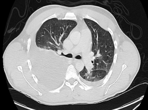 A) Contrast-enhanced CT scan showing a large pleural effusion in the right chest cavity