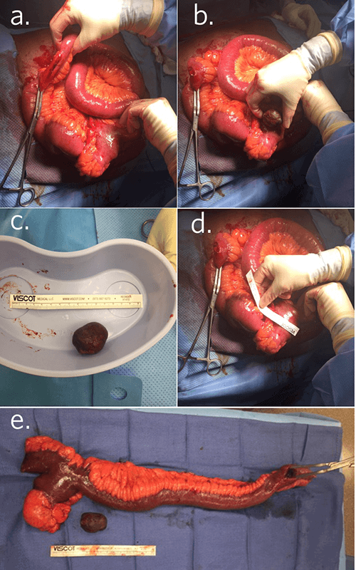 Figure 2. Intraoperative Photos; 2a. Enterotomy and removal of fecalith; 2b. Illustrating similarity in size of fecalith and Meckel diverticulum, suggesting fecalith formed inside diverticulum; 2c. Fecalith measuring approximately 3cm in width; 2d. Diverticula measuring approximately 3 cm in width; 2e. Resection of affected bowel, demonstrating similarity in size between fecalith and Meckel diverticulum, in addition to distance distal from diverticulum where fecalith was found.
