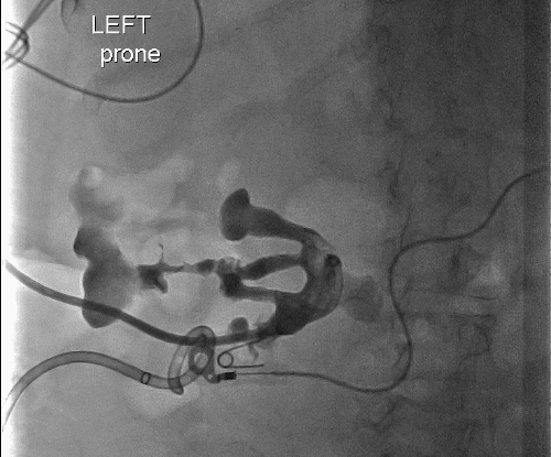 Poor output likely secondary to obstructive nature of staghorn calculus with isolated infundibulum