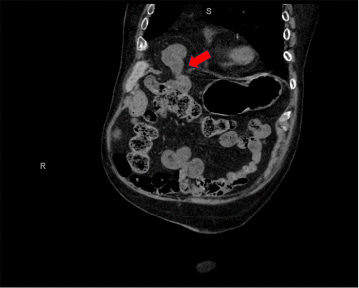 Axial reformatted CT scan of the lower chest and upper abdomen. Note right-sided anterior diaphragmatic defect through which omentum and loops of small bowel (red arrow indicating herniated contents) are seen traversing the right hemidiaphragm and extending into the region of the epicardial fat pad, consistent with a Morgagni hernia