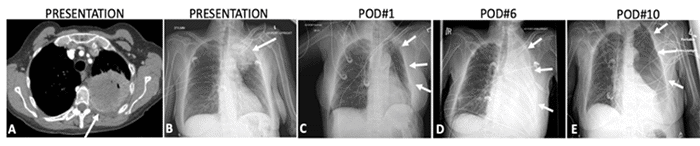 A) Axial chest CT and B) AP chest X-ray at presentation show a necrotic left upper lobe mass (arrows). C) Postoperative day (POD) 1 chest X-ray demonstrates left hemithorax volume loss and air-filled pneumonectomy cavity (arrows). D) POD 6 chest X-ray reveals fluid opacification within the pneumonectomy cavity (arrows). E) POD 10 chest X-ray shows loss of pleural fluid level with new intraluminal air throughout the left pneumonectomy cavity (arrows)