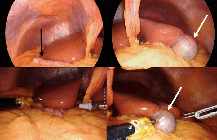Stomach in the right upper quadrant (black arrow); liver and gallbladder in the left upper quadrant (white arrows)