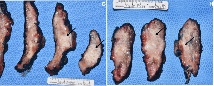 G) Gross pathologic section of right mastectomy specimen with notable areolar base involvement. H) Gross pathologic section of left mastectomy specimen showing poorly circumscribed, tan-white, dense connective tissue infiltrating normal-appearing breast tissue.