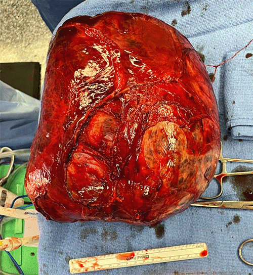 Intraoperative ultrasound facilitated the identification and preservation of major intrahepatic structures, avoiding the need for formal liver resection.