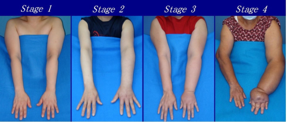 Stages of lymphedema range from mild (Stage 1) to severe (Stage 4). Image Credit: Upper limb lymphedema, by DocHealer, is licensed under CC BY-SA 4.0, via Wikimedia Commons