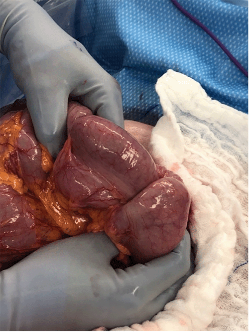 A) Intussuscepted segment prior to resection