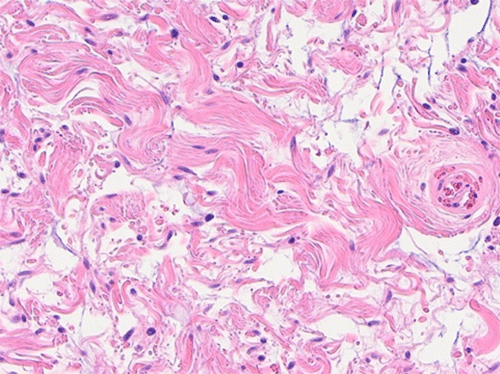 B) 4x: Tumor also demonstrated islands of collagenous and vascular stroma surrounded by pseudovascular channels