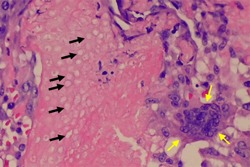 (C) This panel highlights a multinucleated histiocytic giant cell (yellow arrows) surrounding eosinophilic shadow/ghost cells (black arrows)
