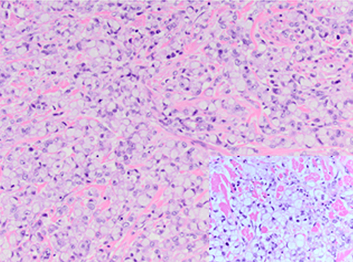 Adipocyte Atrophy Mimicking Signet Ring Cell Carcinoma of the Gallbladder