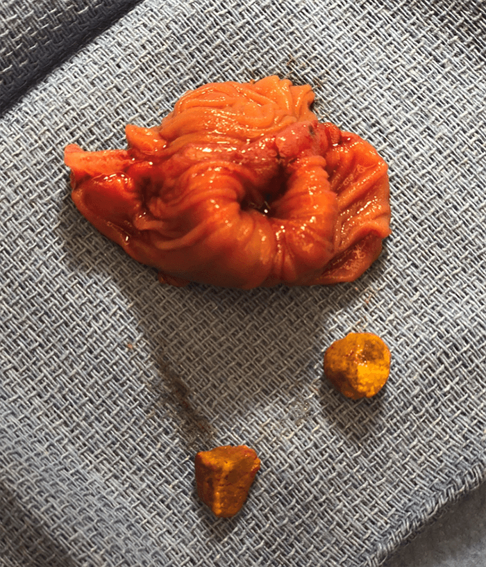 Figure 3. Intraoperative Photograph of Specimen. Two proximal scybala which were creating a ball-valve mechanism. Proximal side facing up