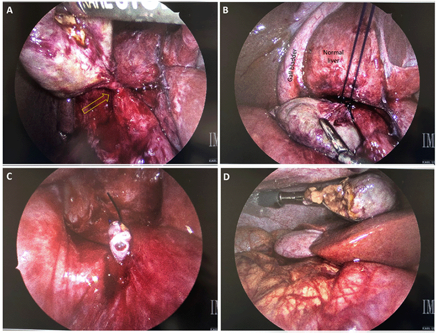 A) Mass elevated with grasper demonstrating torsed pedicle. B) Endoloop suture passed around pedicle with mass retracted inferiorly; C) thrombosed lumen of pedicle. D) In situ view of specimen (with small area of torn capsule).