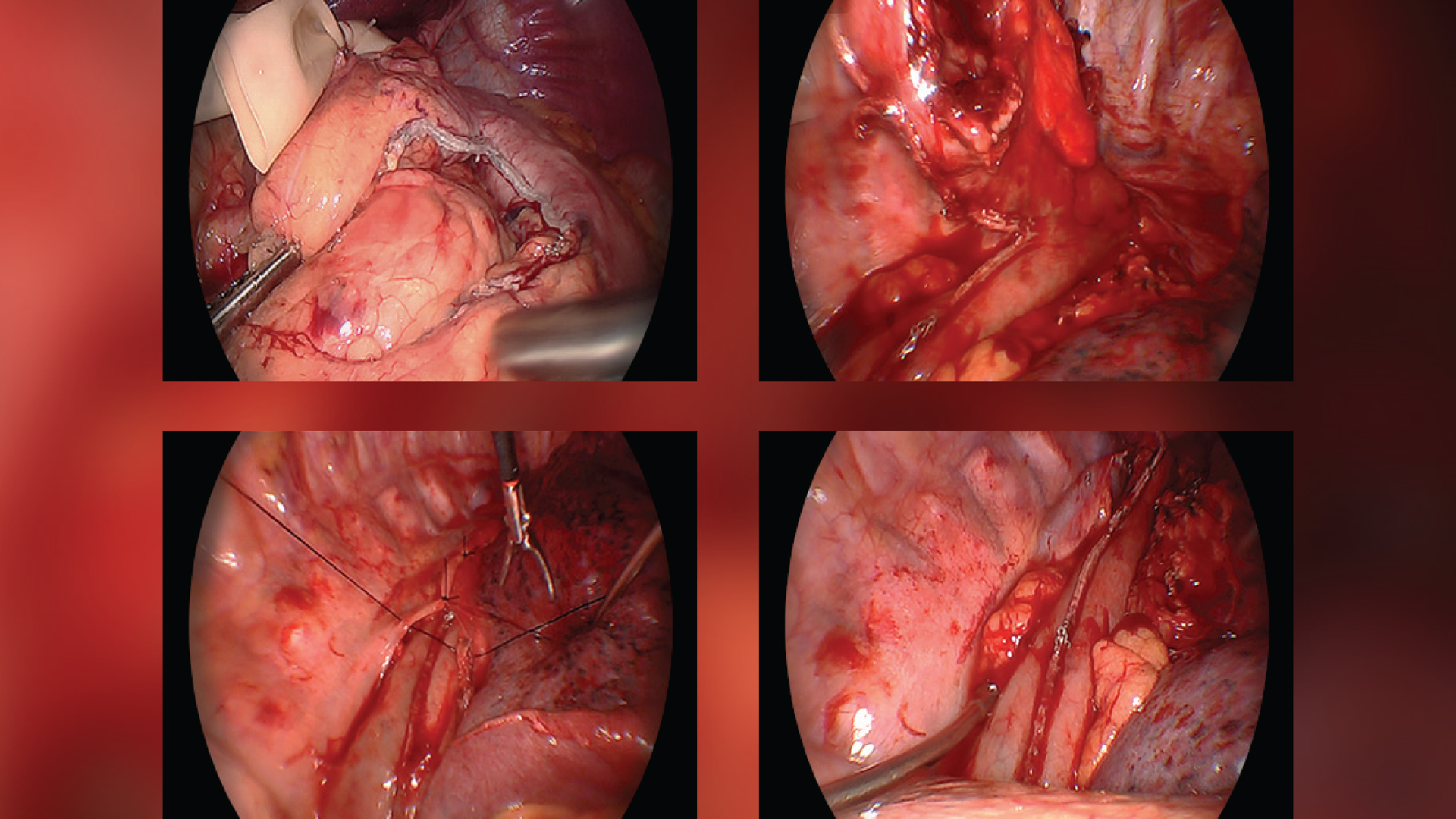 Surgeons Discuss How They Are Humanizing the Esophagectomy in February Bulletin