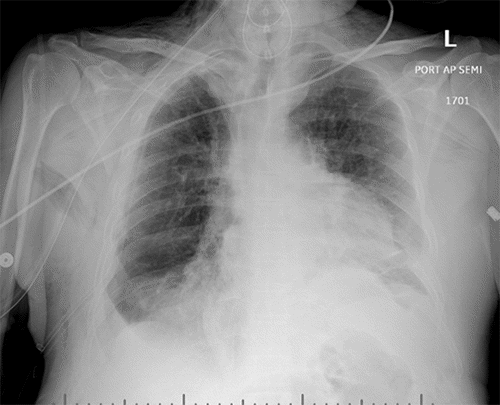 Anteroposterior chest X-ray obtained on postoperative day 0, immediately following the initial diaphragmatic hernia repair