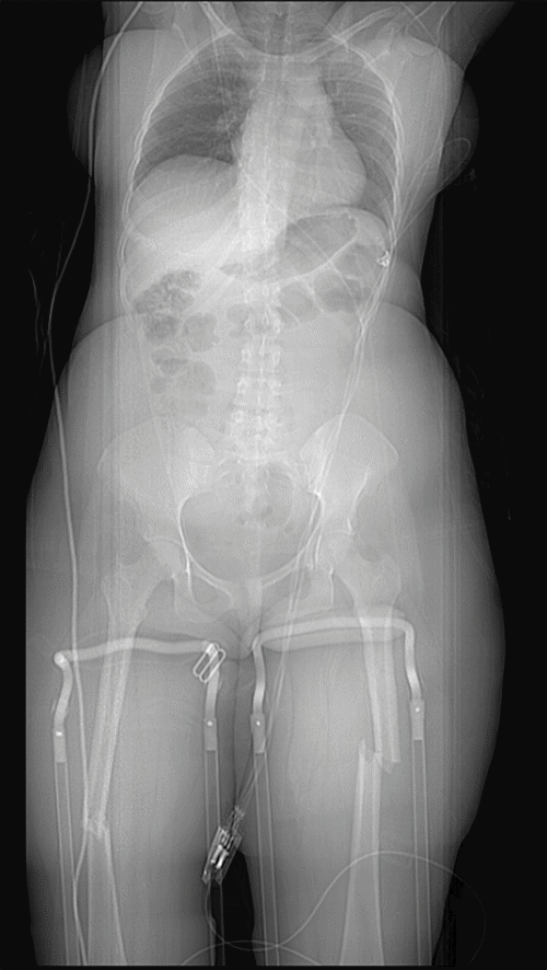 Anteroposterior radiograph of the bilateral femurs obtained upon initial presentation, demonstrating acute, displaced fractures of the femoral shafts