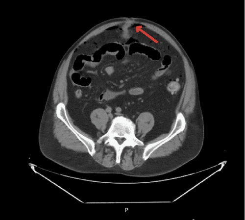 A) Abdomen axial view with Meckel’s diverticulum present in hernia sac protruding through fascia (arrow)