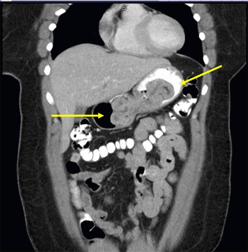 Image confirmed a large, well-defined mass within the gastric body