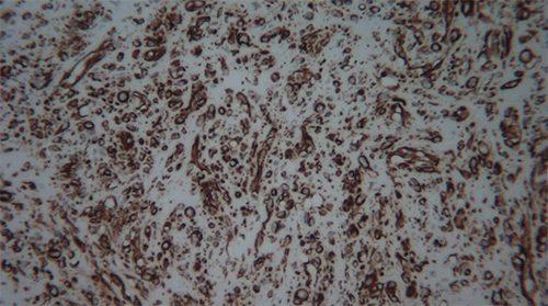 Intermediate magnification (20x) showing sheets of spindle cells positive for vimentin