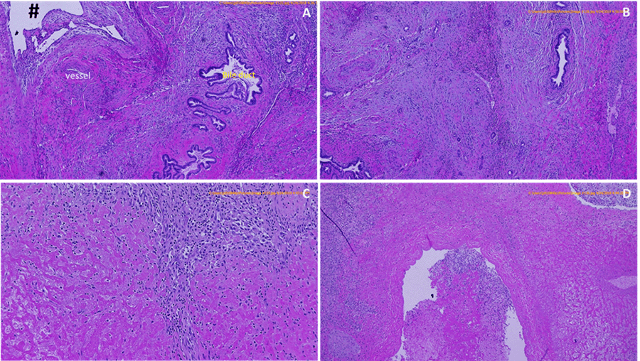 A) Mesenchymal hamartoma consisting of abundant fibromyxoid mesenchymal stroma, abnormal bile ducts with periductal collaring of stromal cells, cystic structures (#), blood vessels and hepatic tissue (*) B) Bile duct structures show abnormal configuration accompanying periductal collaring of stromal cells and abundant fibromyxoid stroma. Bile ducts tortuous and small C) Hepatocyte coagulative necrosis with peripheral organizing changes D) Hepatocyte coagulative necrosis and intravascular organizing thrombus