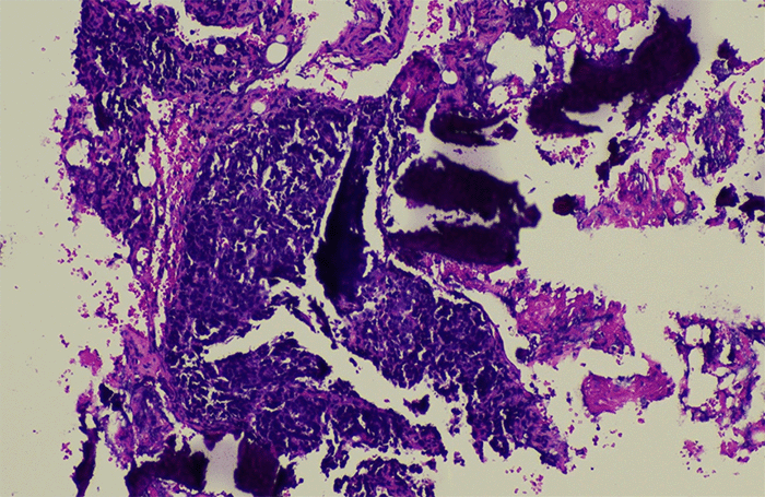 Photomicrograph of the femoral bone biopsy. The specimen reveals malignant glandular structures composed of atypical epithelial cells infiltrating the native bone matrix, consistent with poorly differentiated adenocarcinoma of colorectal origin