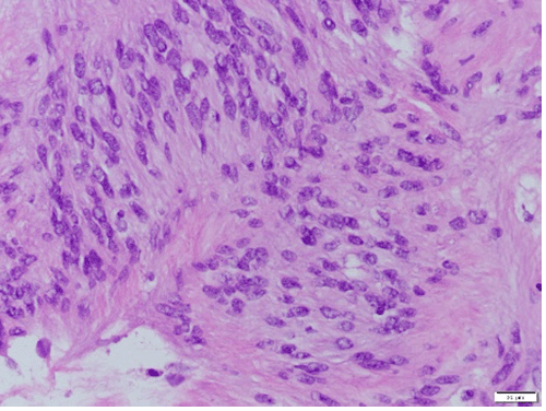 Haemotoxylin and eosin (H&E) staining at 40x magnification demonstrates characteristic hypercellular palisading pattern around fibrillary process commonly found in schwannomas