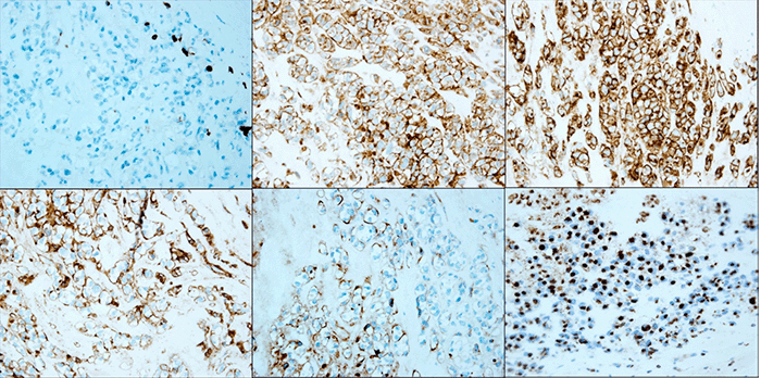 Tumor cells are negative for CD3 (top left) and show positivity for CD4 (top-middle), CD30 (top-right), and CD43 (bottom-left) (immunohistochemistry stain). Tumor cells are focally positive for epithelial membrane antigen (bottom-middle) and cytotoxic marker TIA-1 with prominent Golgi pattern (bottom-right) (immunohistochemistry stain).