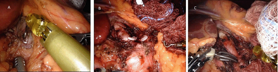 A) Beginning of procedure before release; B) complete dissection and release of celiac artery; and C) exposed celiac artery take off