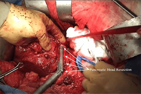 Figure 2. Pancreatic head harvest. White arrows are pointing to the Endo GIA™ staple line used to transect the pancreatic head.