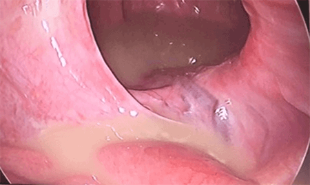 Figure 1. Laparoscopic view of abdomen, collection within the left hernial sac
