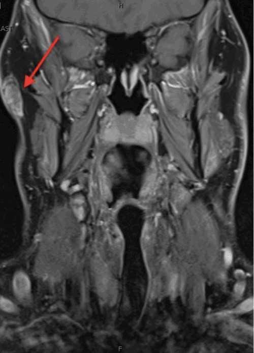 Coronal T1-weighted fat-suppressed (FS) image post-contrast, illustrating the lesion (arrow) with peripheral and some internal enhancement, confirming its superficial location without invasion of the parotid gland or external auditory canal