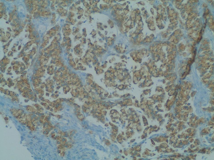 Figure 2. Primary goblet cell carcinoid tumor staining positive for neuron-specific enolase