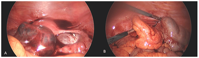 (A) Dilated left fallopian tube containing approximately 200 mL of blood clots. Blood products are also visualized within the pelvis; (B) Thickened and dilated appendix with a thickened mesentery