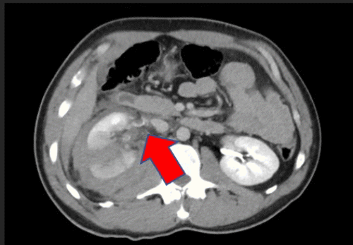 B) Grade IV right kidney injury with perinephric hematoma and possible injury to the proximal ureter (arrow), evident on delayed films.