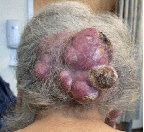 A) In vivo view of the scalp mass demonstrating its multinodular appearance