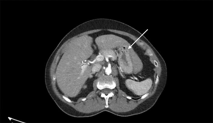 The arrow denotes a significant portion of the stomach covered by the liver